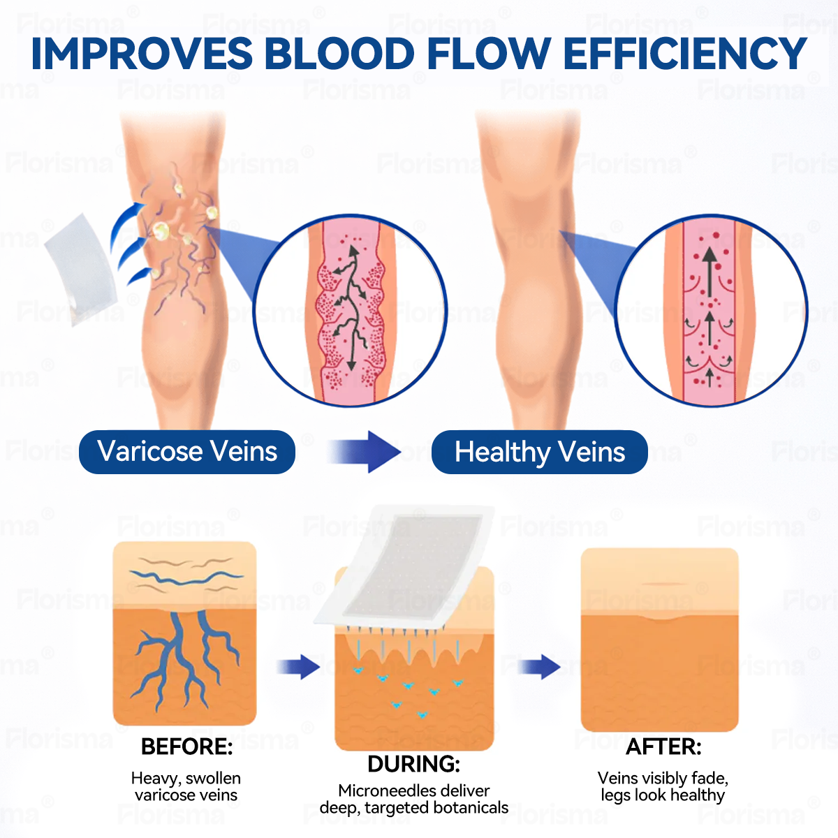 𝑯𝒊𝒗𝒂𝒕𝒂𝒍𝒐𝒔 𝒃𝒐𝒍𝒕 | 🛡️ FLORISMA® Diosmin & Hesperidin klinikai minőségű mikrotűs tapasz ✨ Fejlett gyógynövény-keverék: célzottan pókerekre a nehéz, fáradt lábak enyhítésére