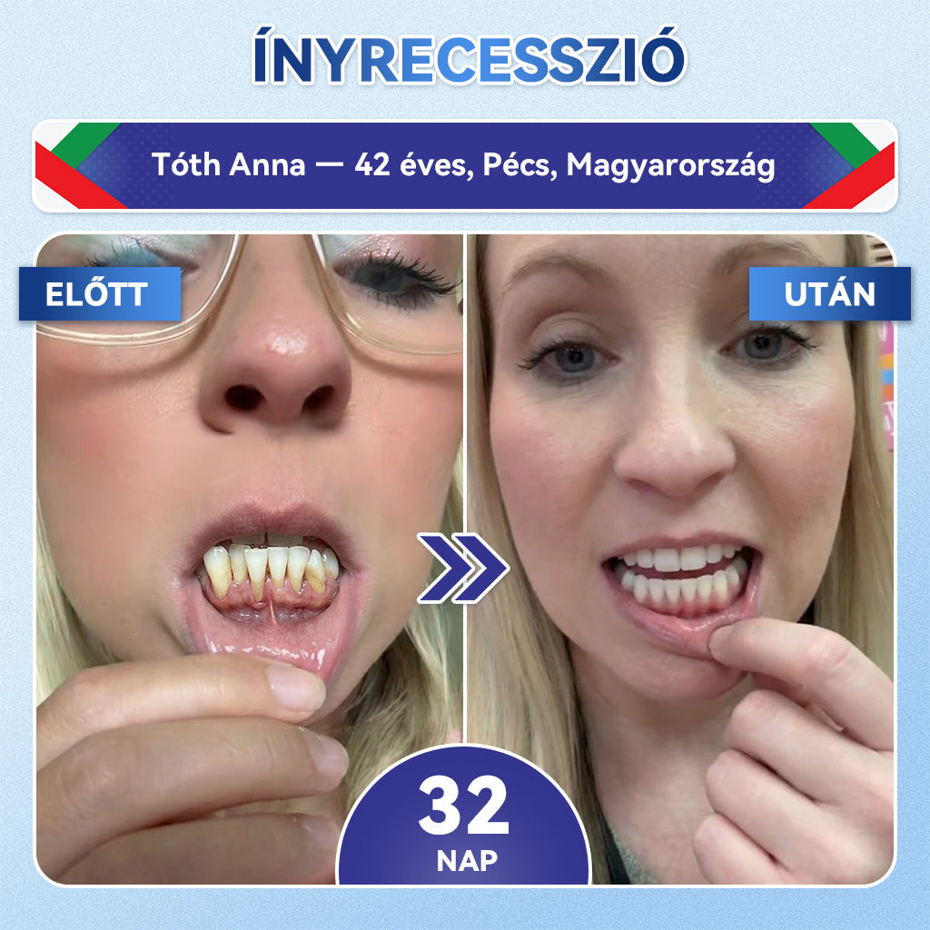 🦷𝐆𝐥𝐢𝐦𝐦𝐞𝐫𝐥𝐲® Tideglusib Fog & íny Javító mikrotűs tapasz | Fejlett őssejt-aktiváló fogcsíkok (újjáépíti a fogzománcot és a dentint • erősíti az ínyt • megszünteti a fogkövet és a szagokat • megállítja a fogérzékenységet)