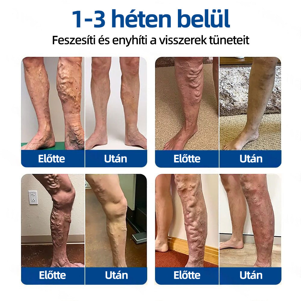✅𝐇𝐞𝐚𝐥𝐫𝐢𝐳𝐞® VeinTarget mikrotűs tapasz🍀Azonnali enyhülés hosszú távú eredmények