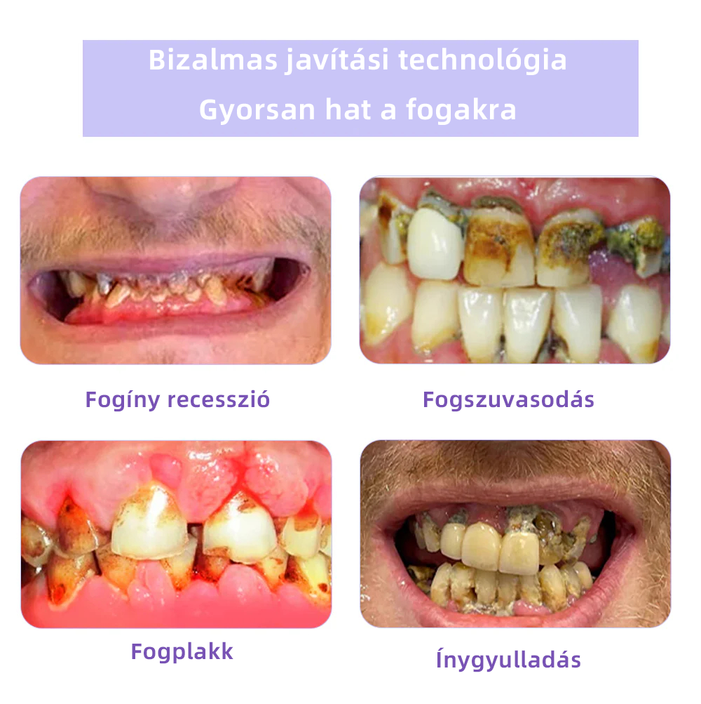 (🔥 Különleges ajánlat utolsó napja - 70% kedvezmény🔥) Spzv™ Fogászati helyreállító ásványi por 🦷 (MOK ajánlásával)