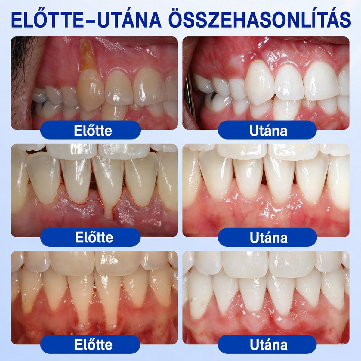 👨‍⚕️✅🦷 HEATWOLF® GumRevive – Parodontális helyreállító gél💞