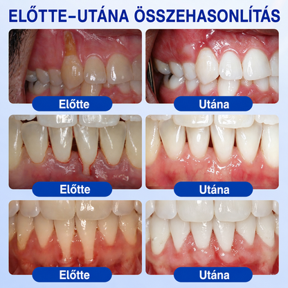 👨‍⚕️✅🦷 HEATWOLF® GumRevive – Parodontális helyreállító gél💞
